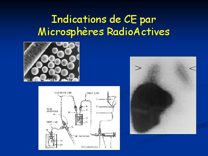 Indications de CE par Microsphères Radio. Actives 