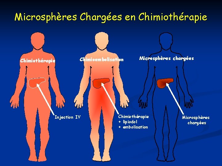 Microsphères Chargées en Chimiothérapie Chimioembolisation Injection IV Microsphères chargées Chimiothérapie + lipiodol + embolisation