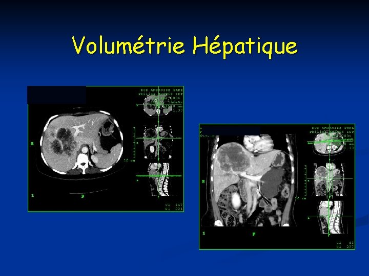 Volumétrie Hépatique 