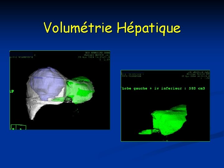 Volumétrie Hépatique 