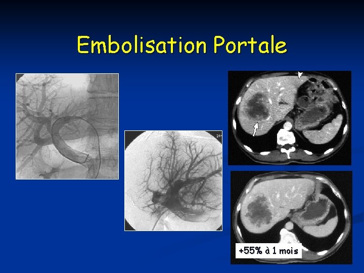 Embolisation Portale +55% à 1 mois 