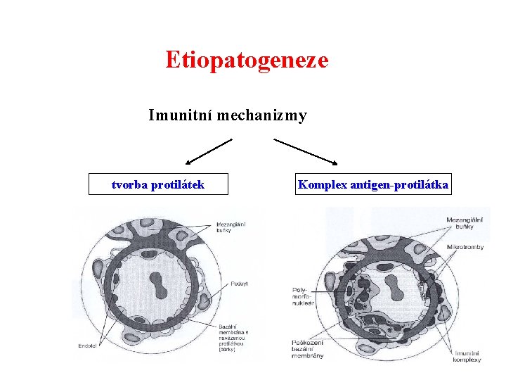 Etiopatogeneze Imunitní mechanizmy tvorba protilátek Komplex antigen-protilátka 