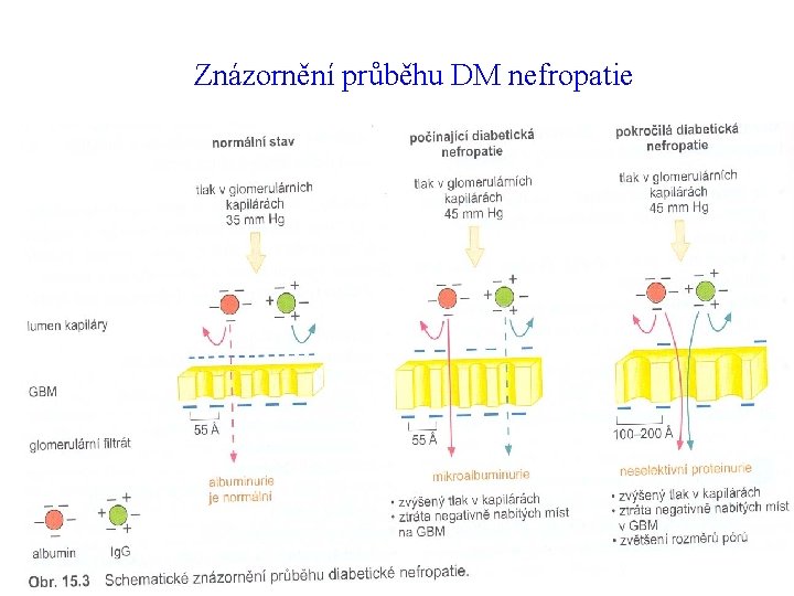 Znázornění průběhu DM nefropatie 