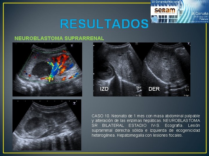 RESULTADOS NEUROBLASTOMA SUPRARRENAL IZD DER CASO 10. Neonato de 1 mes con masa abdominal