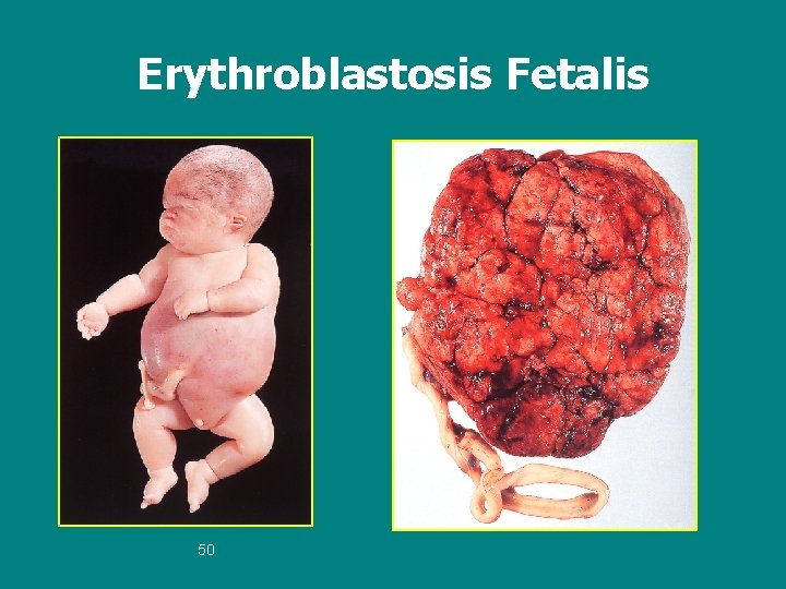 Erythroblastosis Fetalis 50 