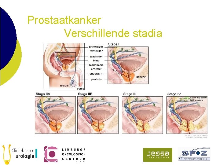 Prostaatkanker Verschillende stadia 