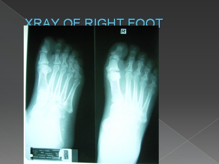 XRAY OF RIGHT FOOT 