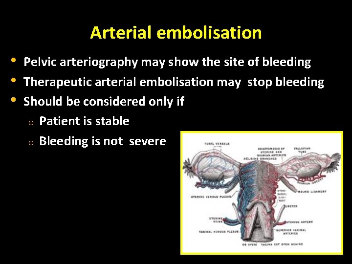 Arterial embolisation • • • Pelvic arteriography may show the site of bleeding Therapeutic