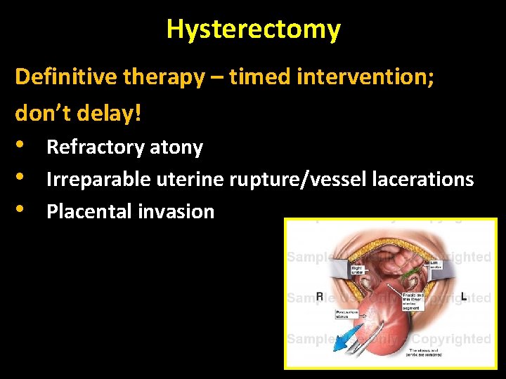 Hysterectomy Definitive therapy – timed intervention; don’t delay! • • • Refractory atony Irreparable
