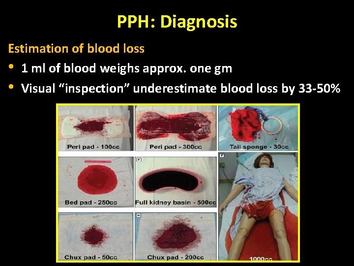 PPH: Diagnosis Estimation of blood loss • 1 ml of blood weighs approx. one