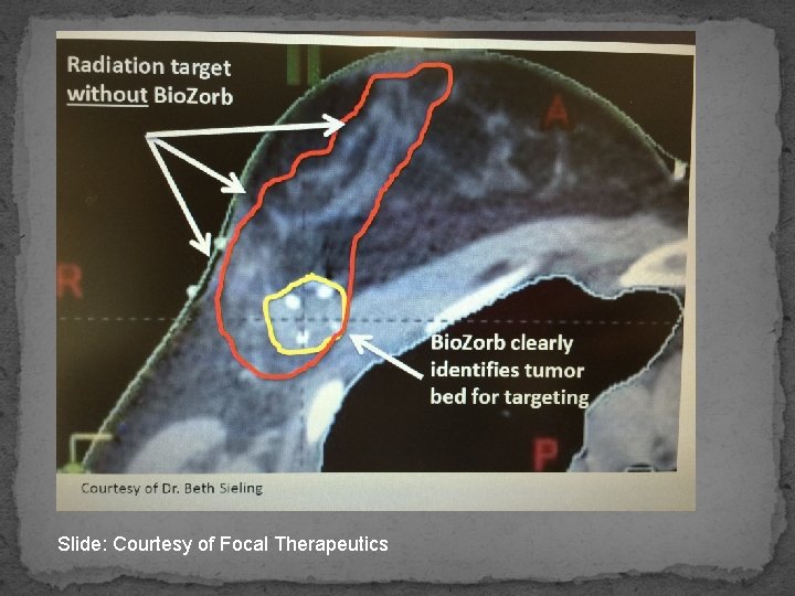 Slide: Courtesy of Focal Therapeutics 