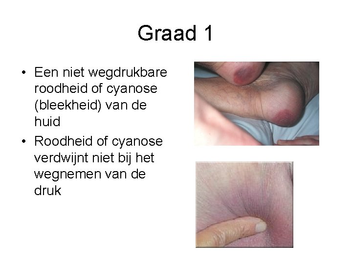 Graad 1 • Een niet wegdrukbare roodheid of cyanose (bleekheid) van de huid •