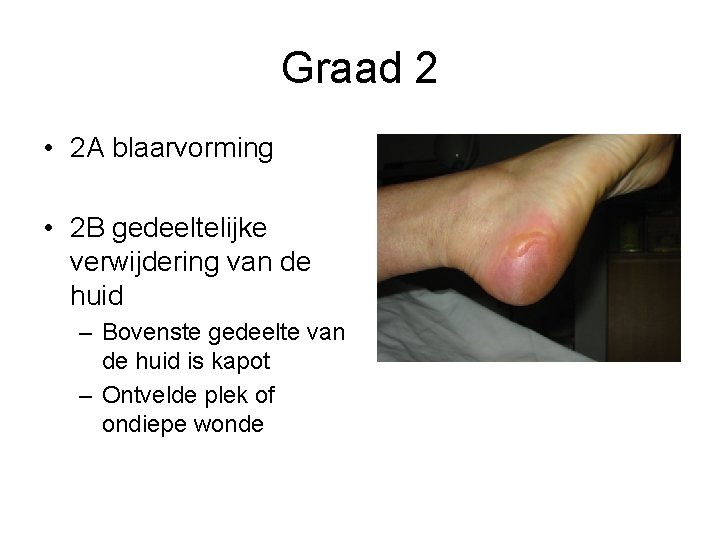 Graad 2 • 2 A blaarvorming • 2 B gedeeltelijke verwijdering van de huid