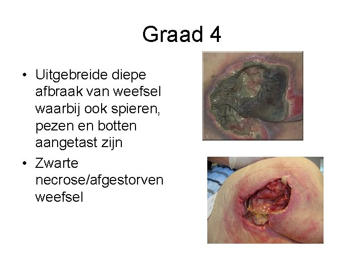 Graad 4 • Uitgebreide diepe afbraak van weefsel waarbij ook spieren, pezen en botten