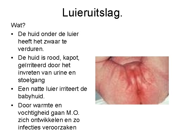 Luieruitslag. Wat? • De huid onder de luier heeft het zwaar te verduren. •