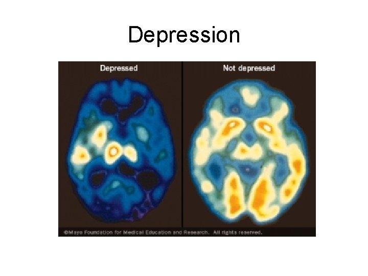 Depression 