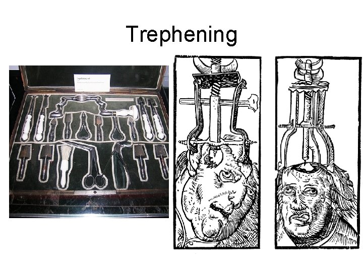 Trephening 