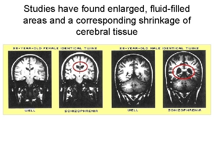Studies have found enlarged, fluid-filled areas and a corresponding shrinkage of cerebral tissue 