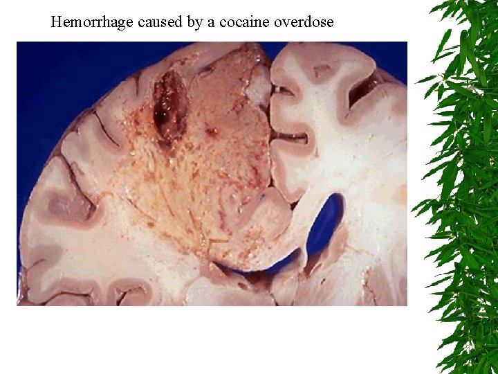 Hemorrhage caused by a cocaine overdose 