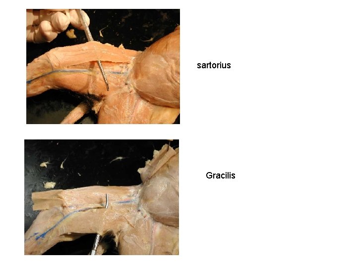 sartorius Gracilis 