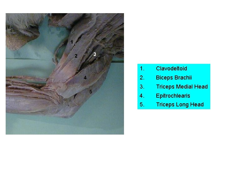 1. Clavodeltoid 2. Biceps Brachii 3. Triceps Medial Head 4. Epitrochlearis 5. Triceps Long