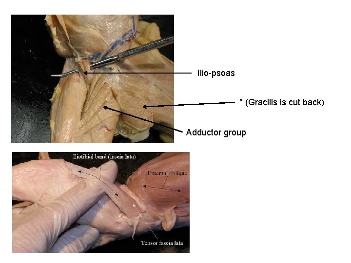 Ilio-psoas * (Gracilis is cut back) Adductor group 