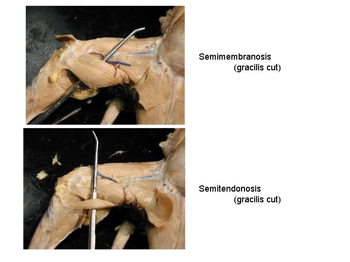 Semimembranosis (gracilis cut) Semitendonosis (gracilis cut) 