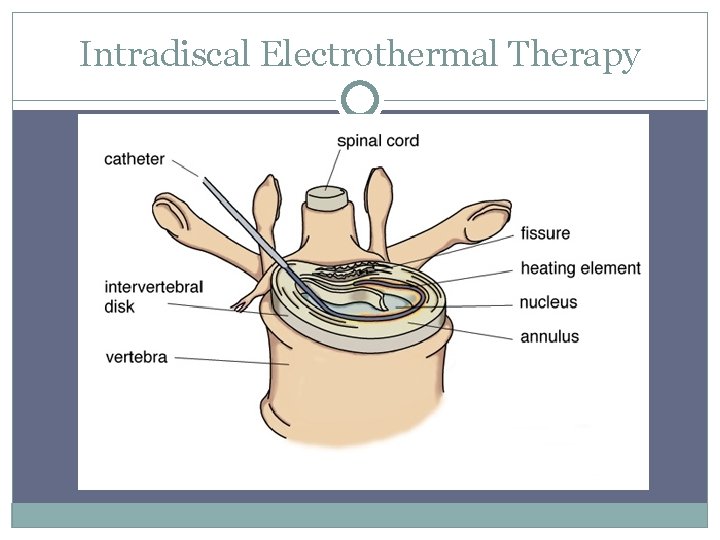 Intradiscal Electrothermal Therapy 