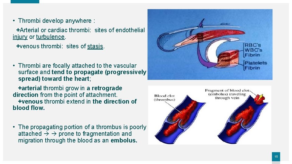  • Thrombi develop anywhere : +Arterial or cardiac thrombi: sites of endothelial injury