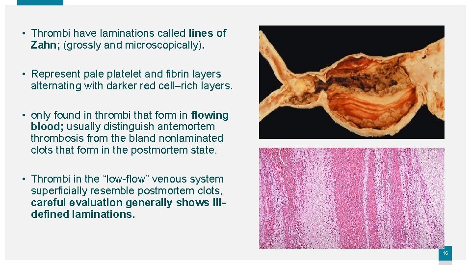  • Thrombi have laminations called lines of Zahn; (grossly and microscopically). • Represent