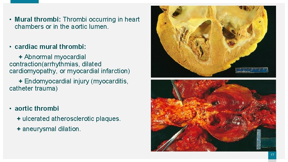  • Mural thrombi: Thrombi occurring in heart chambers or in the aortic lumen.