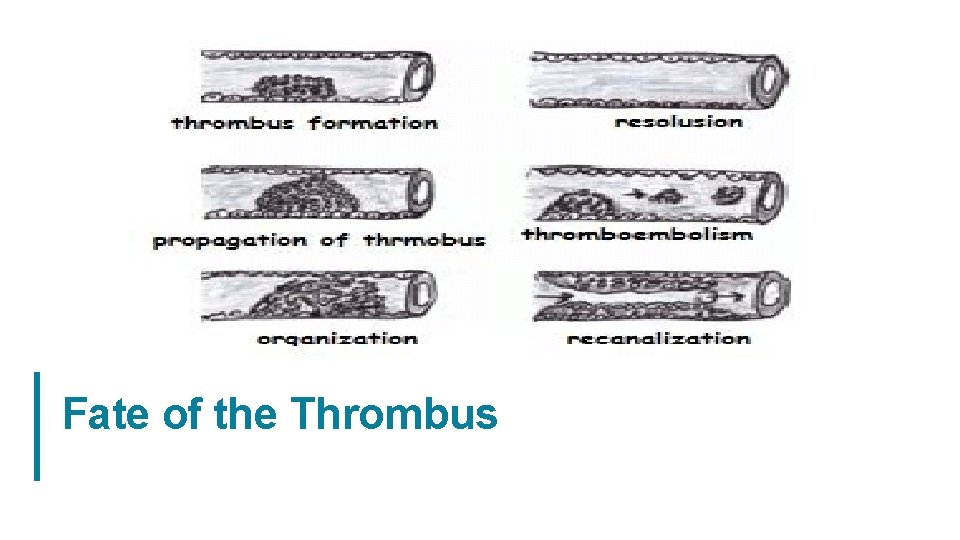 Fate of the Thrombus 20 