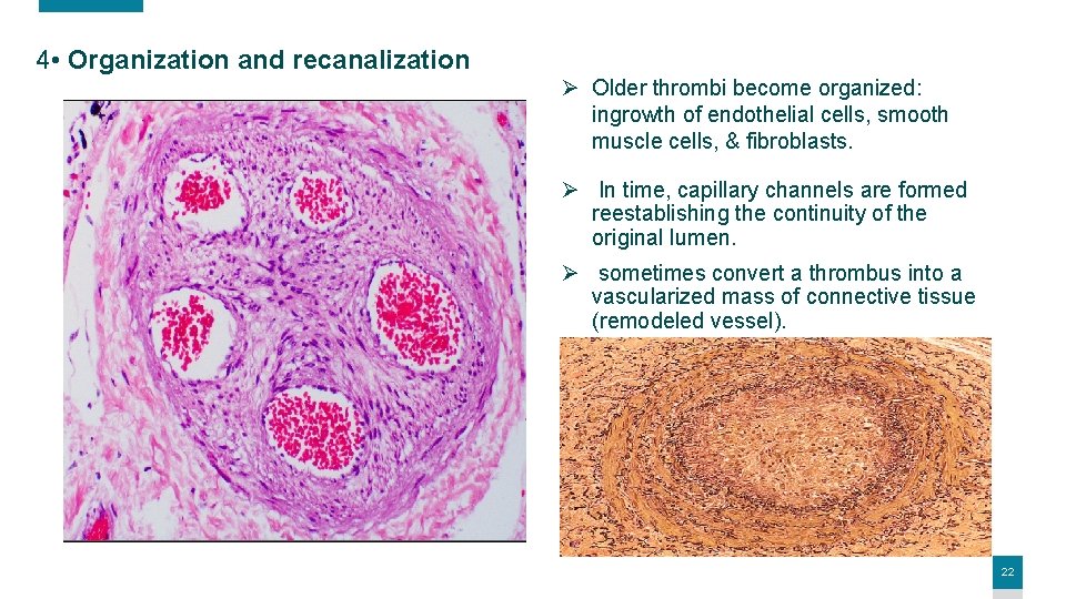 4 • Organization and recanalization Ø Older thrombi become organized: ingrowth of endothelial cells,