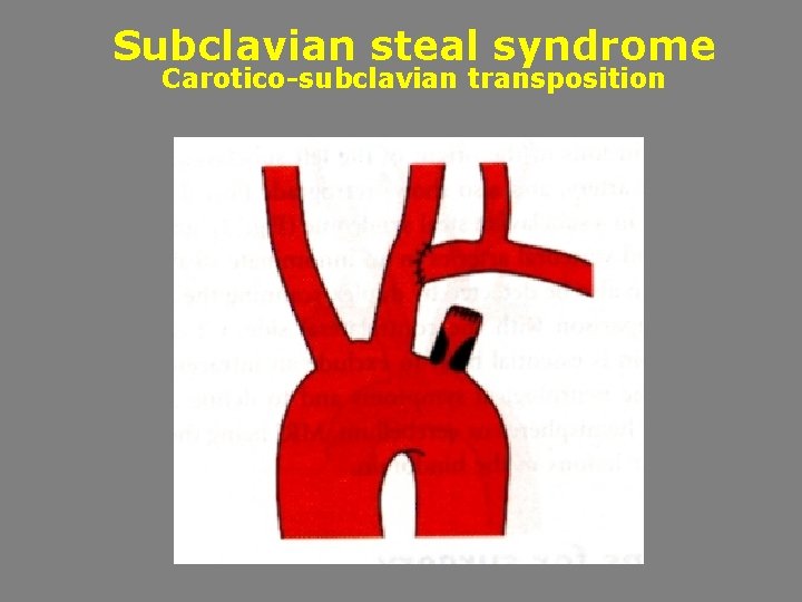 Subclavian steal syndrome Carotico-subclavian transposition 