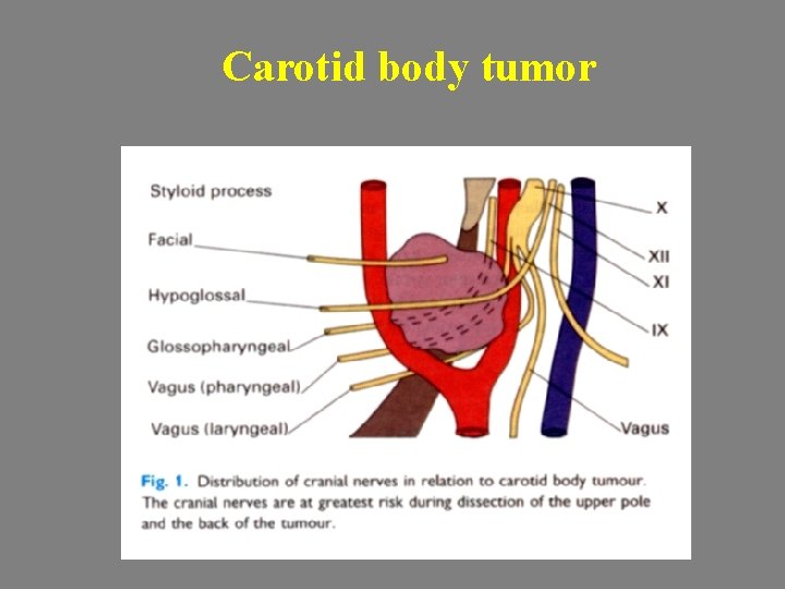 Carotid body tumor 