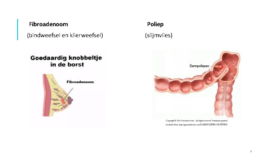 MEDISCHE KENNIS Benigne en maligne gezwellen tumoren MEDISCHE