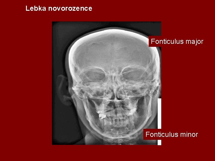 Lebka novorozence Fonticulus major Fonticulus minor 
