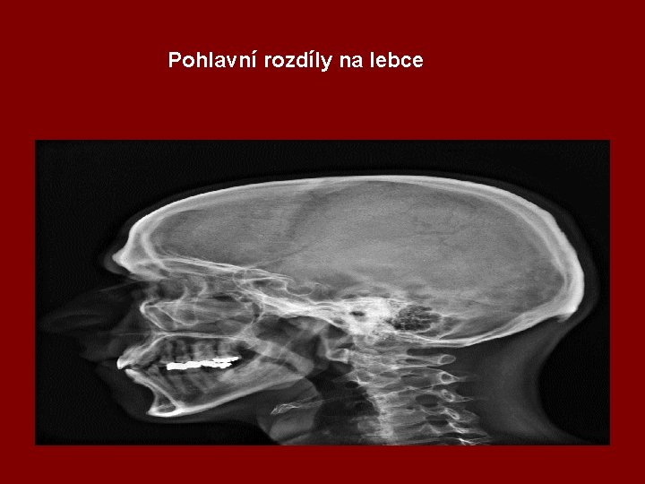 Pohlavní rozdíly na lebce 