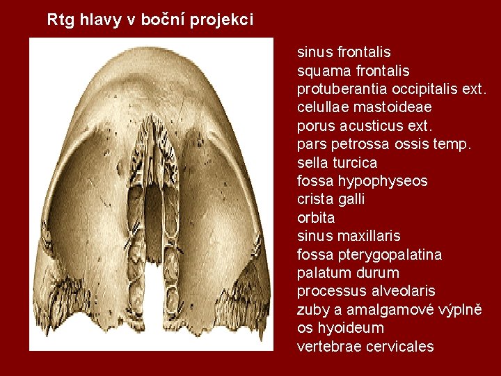 Rtg hlavy v boční projekci sinus frontalis squama frontalis protuberantia occipitalis ext. celullae mastoideae
