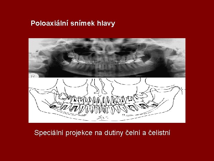 Poloaxiální snímek hlavy Speciální projekce na dutiny čelní a čelistní 