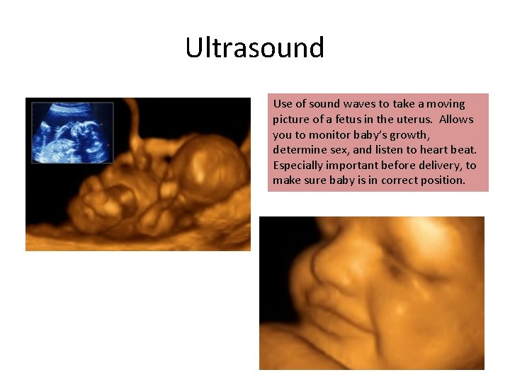 Ultrasound Use of sound waves to take a moving picture of a fetus in