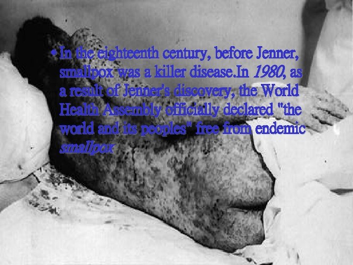 · In the eighteenth century, before Jenner, smallpox was a killer disease. In 1980,