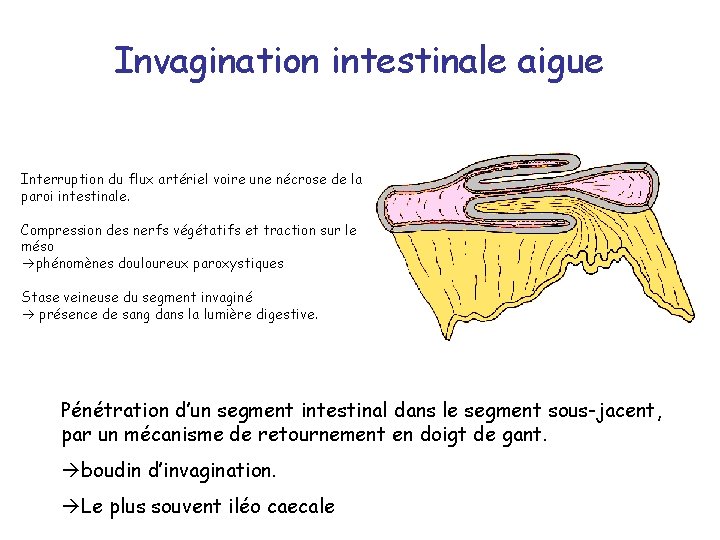 Invagination intestinale aigue Interruption du flux artériel voire une nécrose de la paroi intestinale.