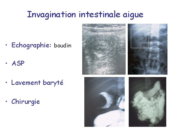 Invagination intestinale aigue • Echographie: boudin • ASP • Lavement baryté • Chirurgie 