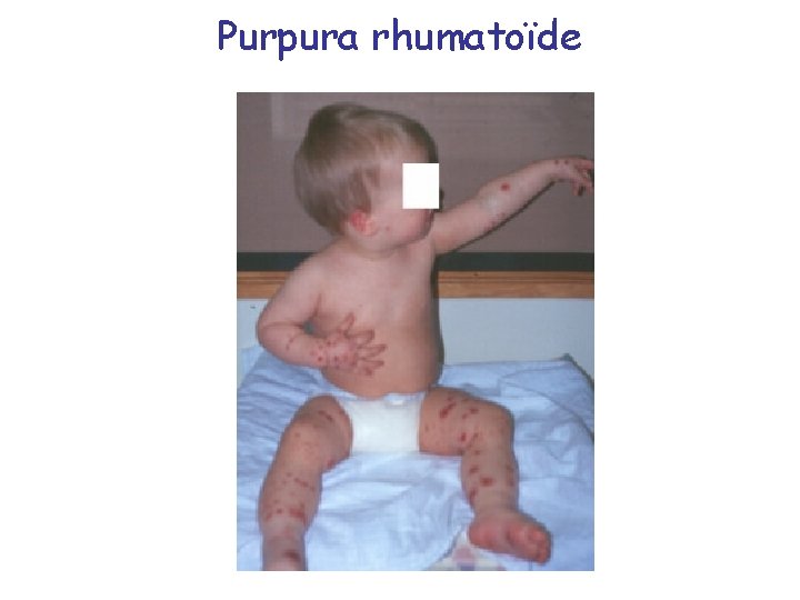 Purpura rhumatoïde 