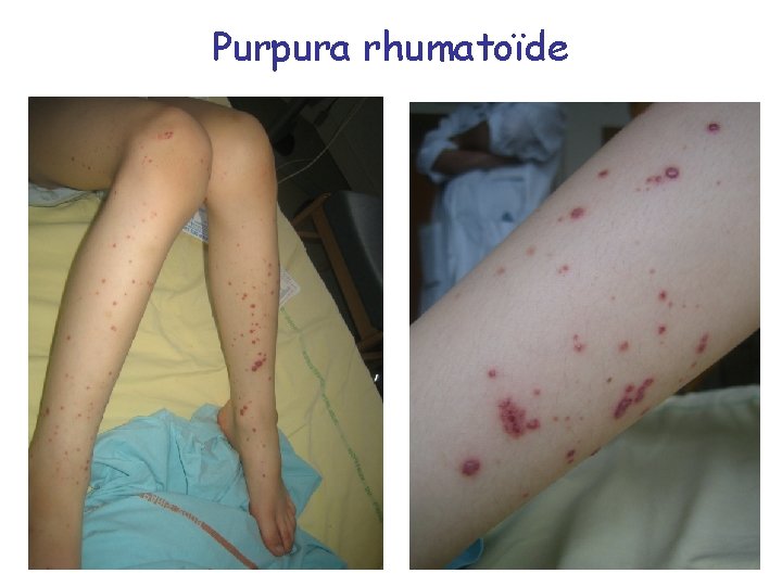 Purpura rhumatoïde 