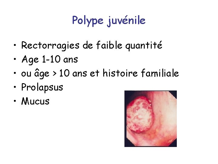 Polype juvénile • • • Rectorragies de faible quantité Age 1 -10 ans ou