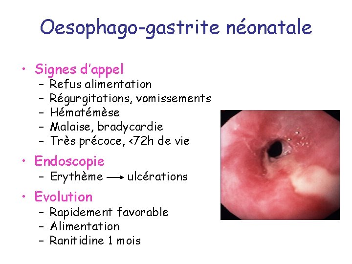 Oesophago-gastrite néonatale • Signes d’appel – – – Refus alimentation Régurgitations, vomissements Hématémèse Malaise,