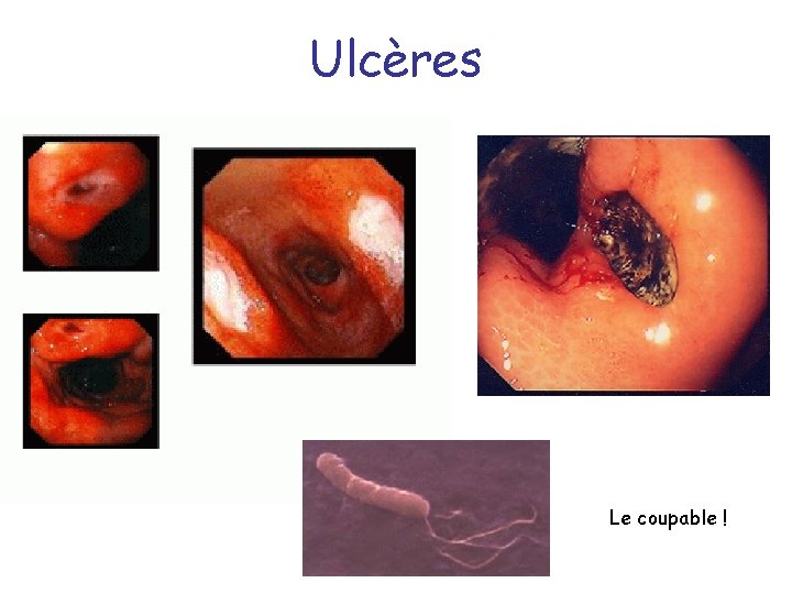 Ulcères Le coupable ! 