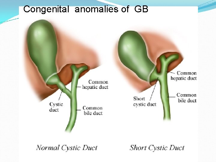 Congenital anomalies of GB 